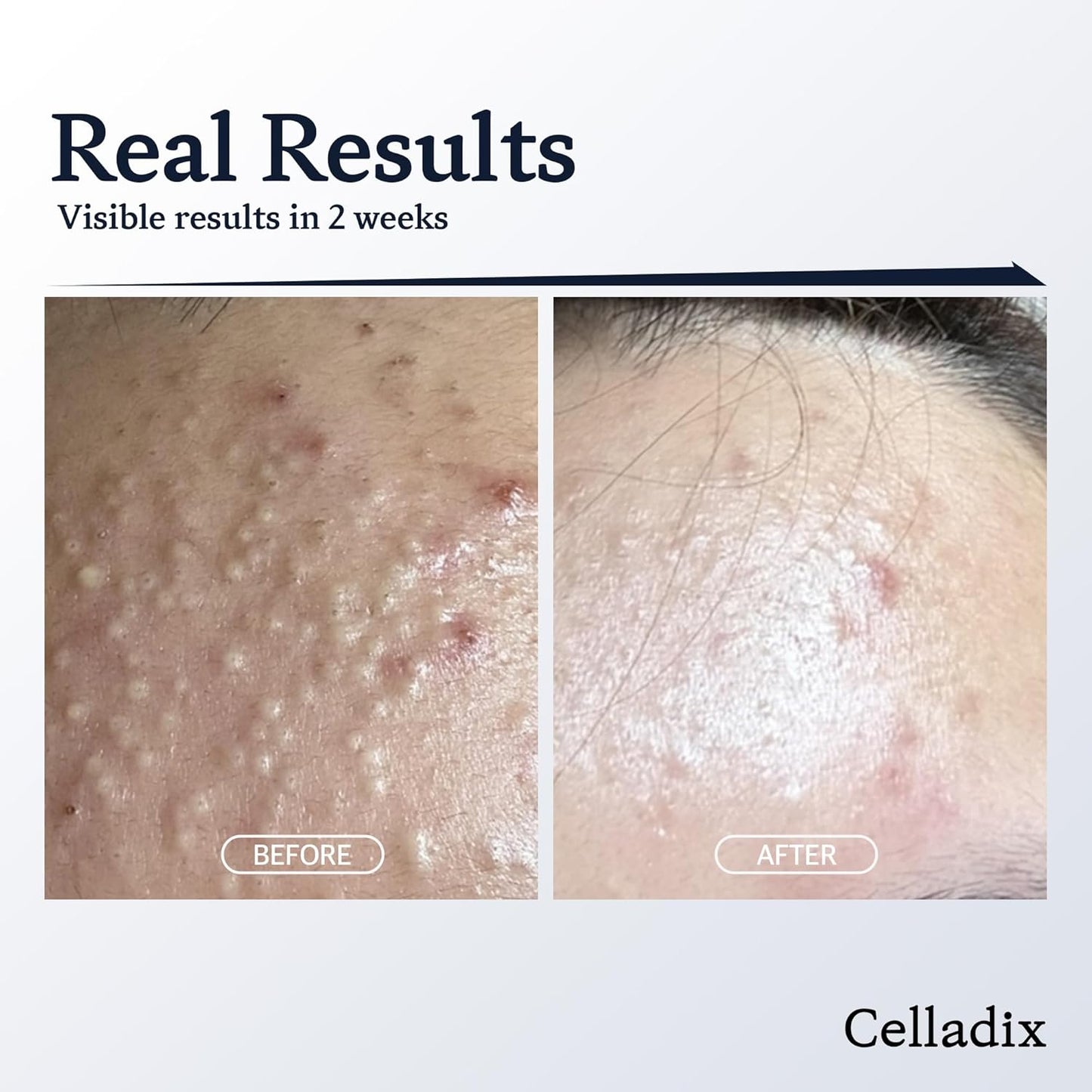 CELLADIX ACNE CONTROL GEL CLEANSER